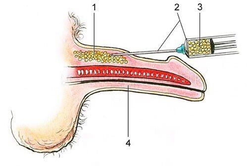 Application of adipose tissue under the skin of the penis